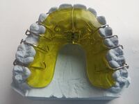 dental-braces-542262_640